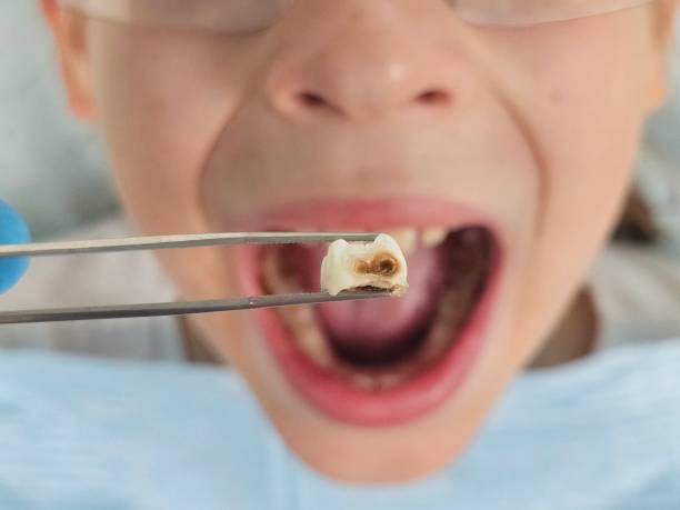 Best Emergency Tooth Extraction in David City, NE